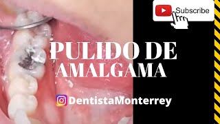 AMALGAMA Dental 👅 PULIDO [upl. by Inaliel793]