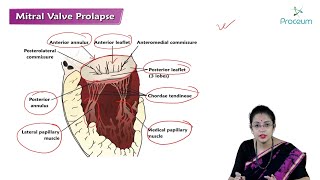 Mitral Valve Prolapse Hindi  Etiology Clinical Features Diagnosis Treatment Complications 🫀🫀🫀 [upl. by Adorne]