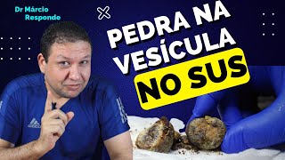 Cirurgia de PEDRA NA VESÍCULA aberta ou por vídeo  Colecistectomia videolaparoscópica e aberta [upl. by Peggi39]