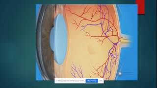 Cystoid Macular Oedema [upl. by Nywled]