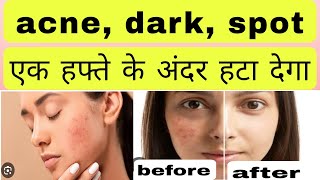 Cosmelite creamacne dark spot एक हफ्ते में हटा देगा uses in Hindi [upl. by Hali127]