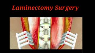 Laminectomy Surgery Animation  Lumbar spine surgery  Joshna Medical Education viral short [upl. by Olinad]