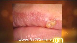 Herpes Treatment with Acyclovir Cream [upl. by Helman489]