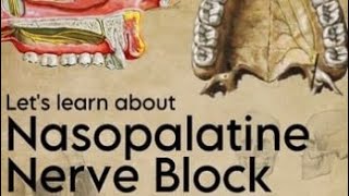 Nasopalatine nerve block  Local Anesthesia in Dentistry  Maxillary Nerve Blocks  Infraorbital [upl. by Alleber208]