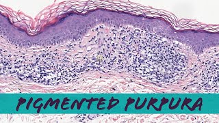 Pigmented Purpuric Dermatosis Schamberg disease lichen aureus etc pathology dermatology [upl. by Dianthe]