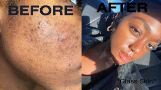 HOW I CLEARED MY ACNE FOR GOOD IN A MONTH one product that changed my life  SKINCARE ROUTINE 2023 [upl. by Jacquelin]