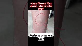 Varicose veins problem solved bengalfouji sscgd medicaltest2024 shorts viralvideo [upl. by Kcerb]