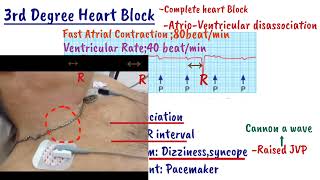 AV Heart Block  First degree heart Block  Mobitz type1  Mobitz type2  Complete heart Block [upl. by Silvio]