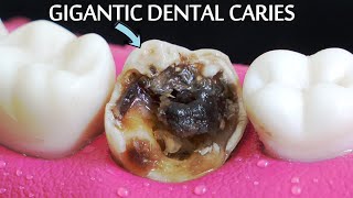 INCREDIBLY SATISFYING Restoration Of Massive Tooth Decay  Root Canal And Crown Process [upl. by Johm]