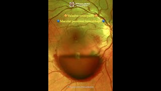 Macular preretinal hemorrhage Valsalva retinopathy [upl. by Laerdna]