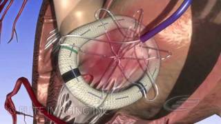 Mitral Heart Valve Ring  Medical amp Scientific Video Production [upl. by Carrelli]