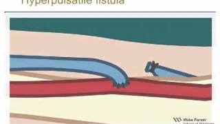 Physical Examination of Arteriovenous Fistula [upl. by Eidoj]