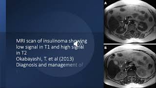 Insulinoma [upl. by Leinehtan645]