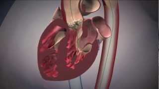 Transfermoral Deployment of Edwards SAPIEN Transcatheter Heart Valve in Calcified Aortic Valve [upl. by Leeda184]