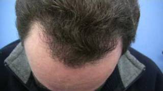 Dr Wong Hair Transplant  3800 Grafts  1 Session [upl. by Gnoy]