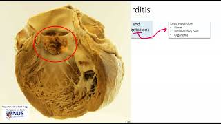 Heart mitral valve Infective endocarditis Microscopy  Talking slide [upl. by Ruhtra]