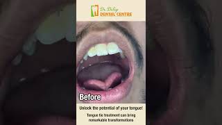 Tongue tie removal with Laser  Dr Dilip Dental Centre [upl. by Eiramaliehs]