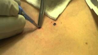 Microdermal Dermal Anchor Removal at MediZen Cosmetic Clinic Birmingham UK [upl. by Ffilc777]