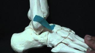 Ankle Sprain ATFL amp Fibula [upl. by Burkitt527]