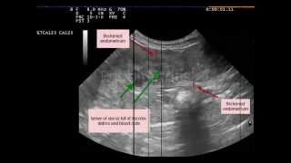 Endometritis not pyometra dog [upl. by Dusa]