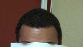 Dense Black Hair Transplant Hairline Restoration Result Bald Treatment Dr Diep wwwmhtacliniccom [upl. by Lledraw]