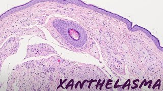 Xanthelasma xanthoma of eyelid yellow bumps around eye pathology dermpath dermatology [upl. by Ambie184]