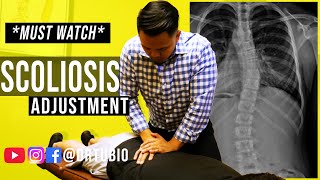 SEVERE SCOLIOSIS pain RELIEVED after Chiropractic Adjustments  Dr Alex Tubio [upl. by Seldon]