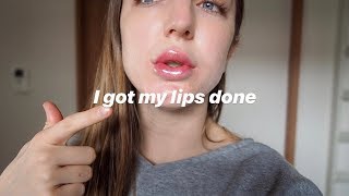 I got Lip Fillers in Japan Day by day recovery cost etc [upl. by Noam11]