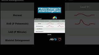 P Wave Changes in Atrial Enlargement [upl. by Seda669]