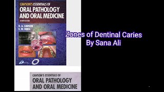 Zones of Dentinal Caries [upl. by Guibert]