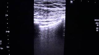 Pleural Sliding SignMP4 [upl. by Swec]