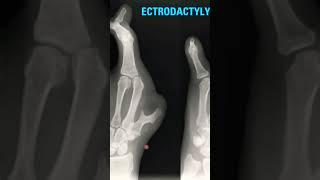 Rare skeletal dysplasia Ectrodactyly radiology anatomy skeleton [upl. by Eiliab933]