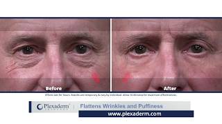 Plexaderm Flattens Wrinkles and Puffiness [upl. by Oirelav426]