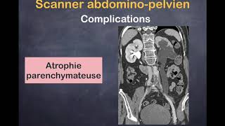 Lithiase Urinaire  4 Complications [upl. by Ayanet]