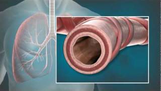 Animation of Bronchial Thermoplasty BT with the Alair® System [upl. by Anaerol]