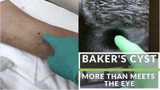 Bakers Cyst More than meets the eye [upl. by Maribelle]