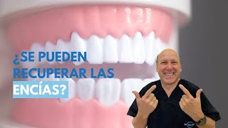 Solución a la Retracción de EncíasRecesión Gingival [upl. by Aiksa]