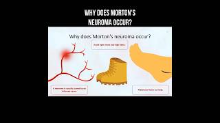 Why does Mortons neuroma occur morton neuroma inflammation nervepainrelief [upl. by Nyleahs]