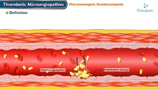 Thrombotic Microangiopathies  TM Thrombotic Thrombocytopenic Purpura  TTP   Hematology [upl. by Lenahc]