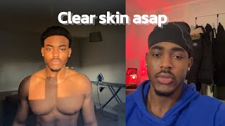 How to get clear skin for guys [upl. by Eelta297]