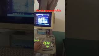 Acute Appendicitis baby boyultrasound appendicitis [upl. by Aerdnahs]