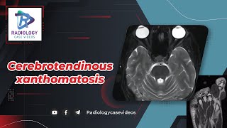 Cerebrotendinous xanthomatosis [upl. by Anuaek]