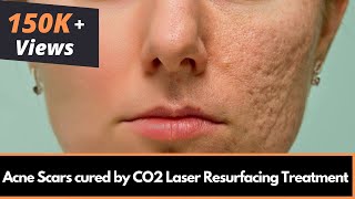 Acne Scars cured by CO2 Laser Resurfacing Treatment  Dr Rinky Kapoor [upl. by Nollahp]