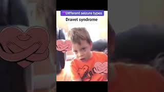 متلازمة درافيت Dravet syndrome [upl. by Nywroc859]