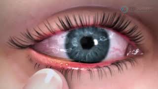 Blepharitis [upl. by Assetnoc939]