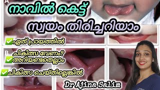 Self examination of Tongue tie malayalam  നാവിലെ കെട്ട് അറിയേണ്ടതെല്ലാം  Dr AjinaSalim tonguetie [upl. by Ahter]