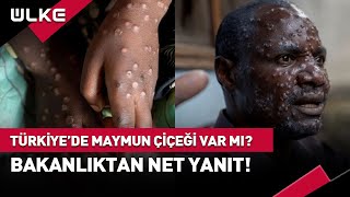 Türkiyede Maymun Çiçeği Virüsü Görüldü Mü Bakanlıktan Net Yanıt haber [upl. by Yung294]