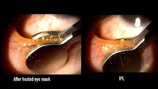 Meibomian gland expression differences with and without IPL [upl. by Munson]