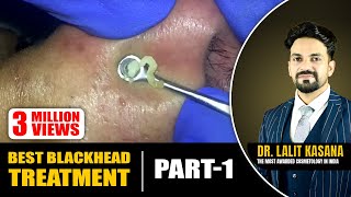 BEST BLACKHEAD TREATMENT PART 1 COMEDONE EXTRACTION NOSE [upl. by Bindman]