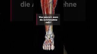 Corpus StudyBuddy Was passiert wenn die Achillessehne reißt [upl. by Kamillah]